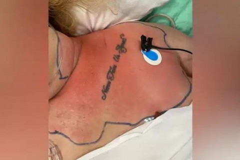 Bactéria “comedora de carne” quase ocasiona morte de mulher