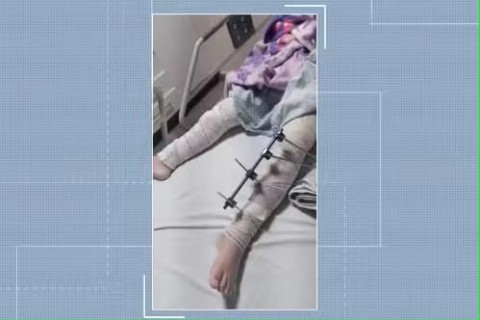 ABSURDO Médicos se enganam e operam perna errada de uma menina de 6 anos na Paraíba