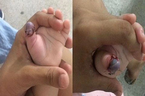 FAMÍLIA RECEIA AMPUTAÇÃO DO DEDO DE BEBÊ APÓS ESPERA DE TRÊS DIAS POR CIRURGIA**